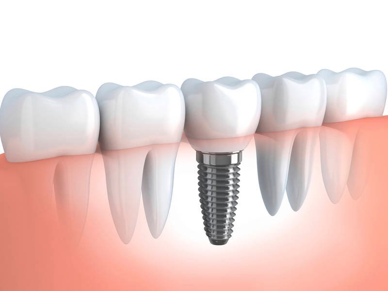 What Are the Signs of Dental Implant Failure?